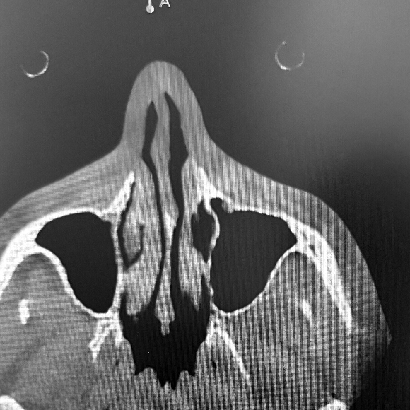 CBCT cross-section showing nasal airway and sinus anatomy