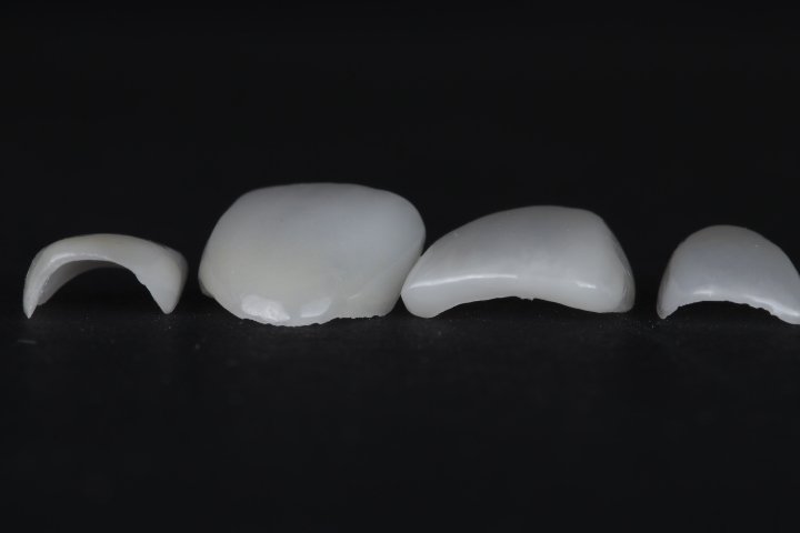 Individual hand-layered porcelain veneers