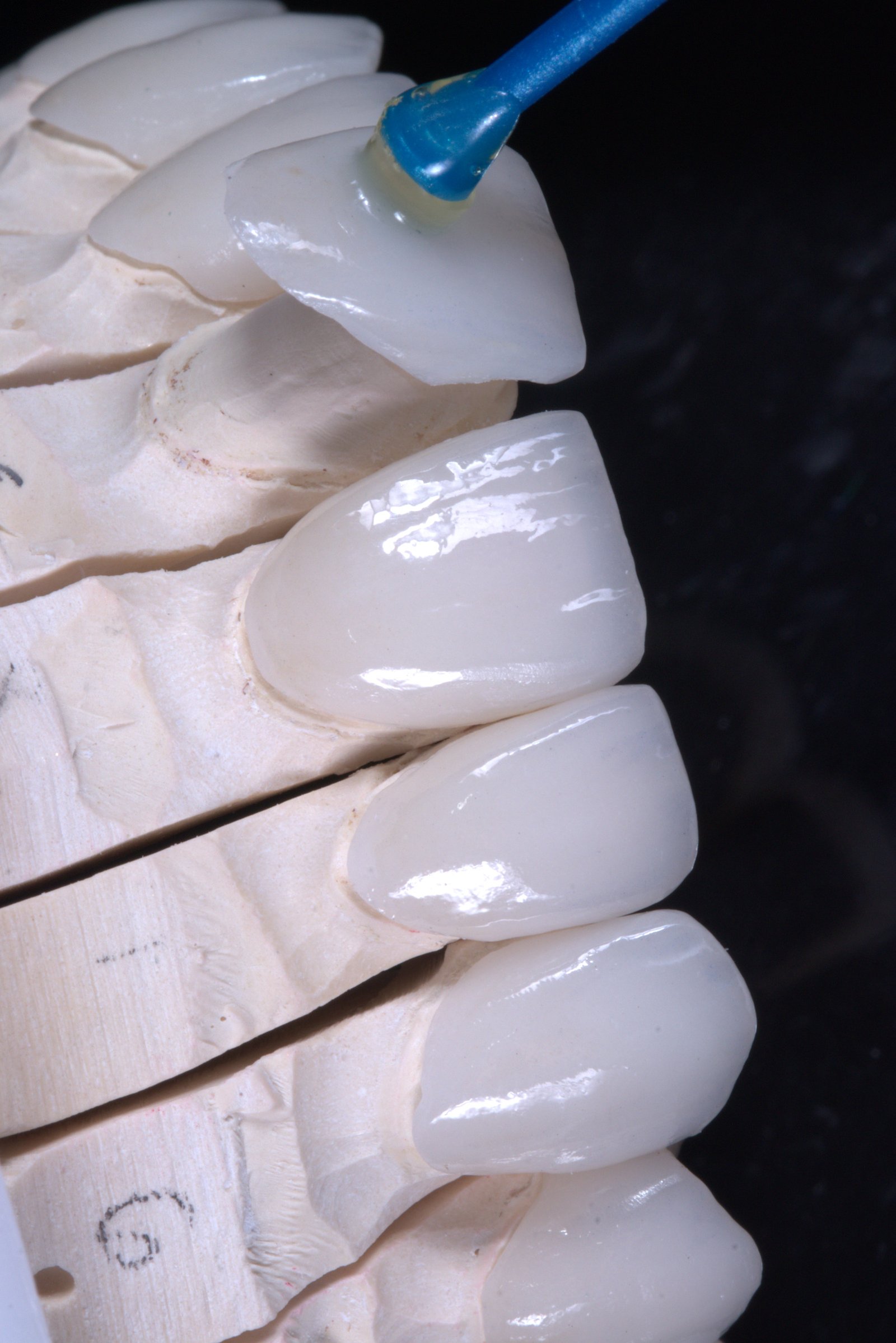 Ceramic veneers on the master model, shade-checked by hand