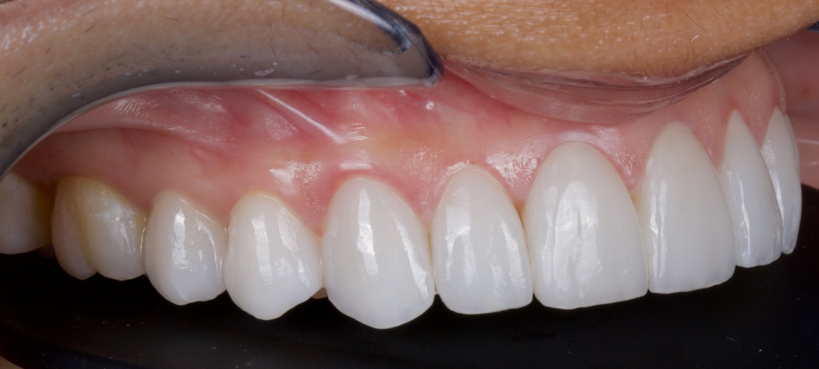 Actual patient of Dr. Silvestrini: veneer try-in, ceramics meeting natural enamel