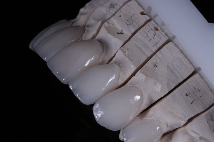 Hand-layered veneers on the master model