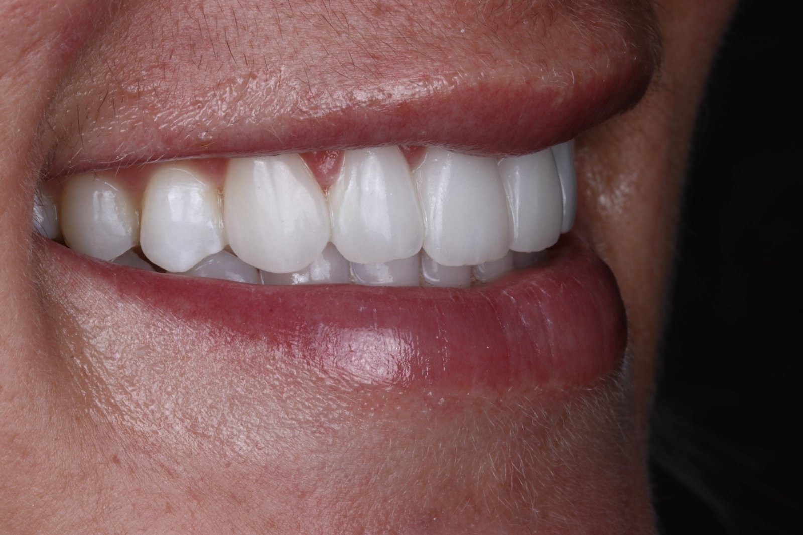 Actual patient of Dr. Silvestrini: porcelain veneers, natural light smile