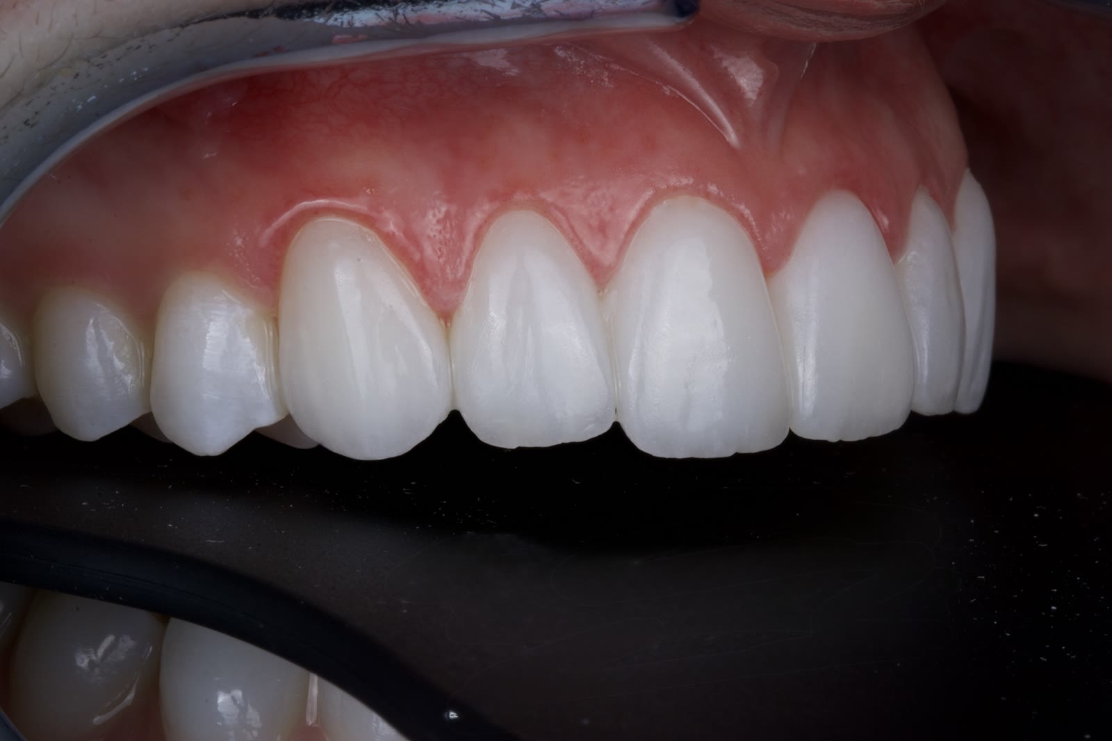 Actual patient of Dr. Silvestrini: upper ceramic veneers, mirror view