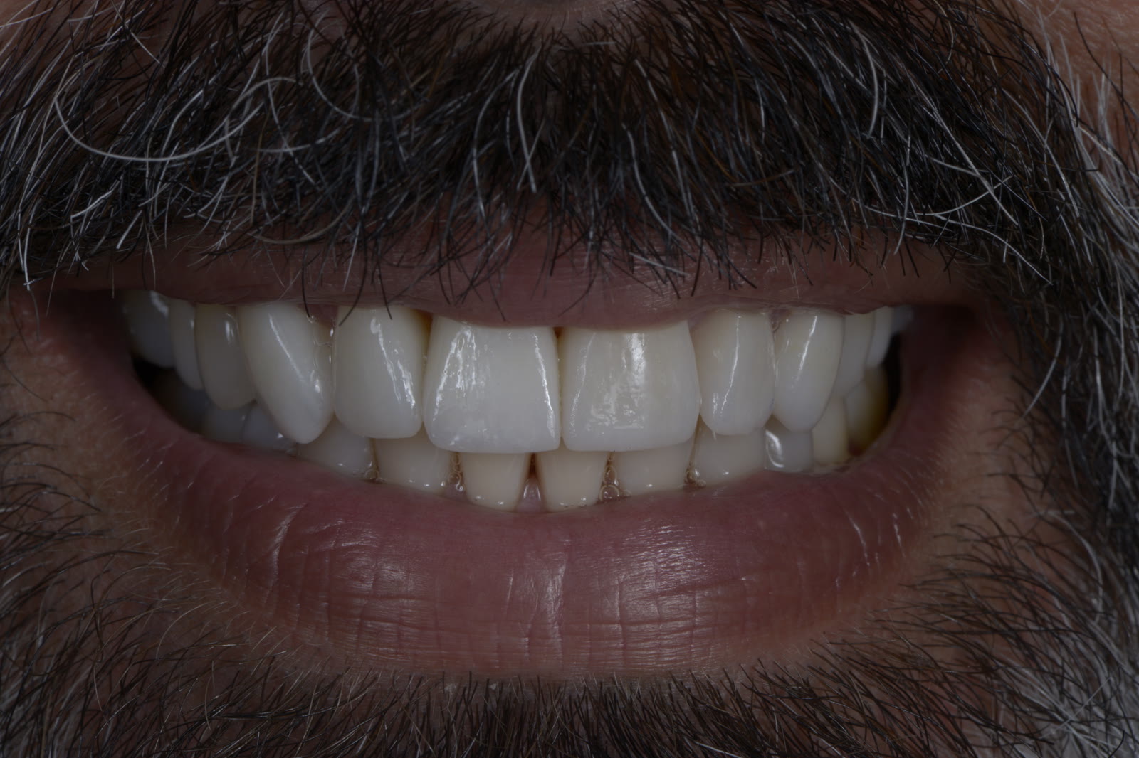 Actual patient of Dr. Silvestrini: refined full smile after ceramic restoration