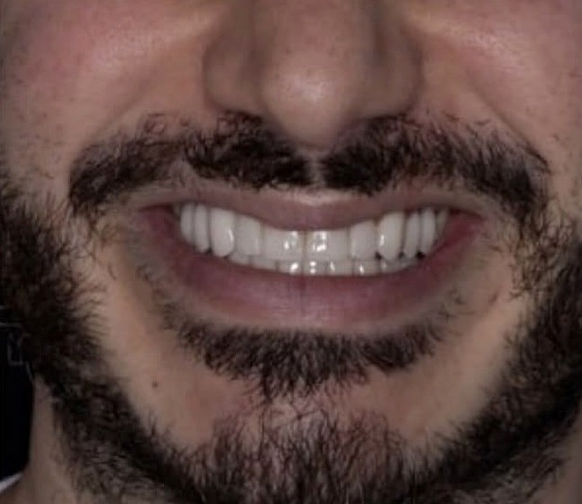 Actual patient of Dr. Silvestrini: full smile after ceramic restoration